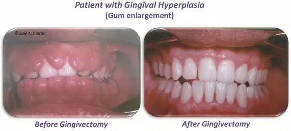 gingival hyperplasia BEFORE AFTER GINGIVECTOMY