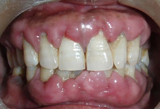 gingival-hyperplasia-pic