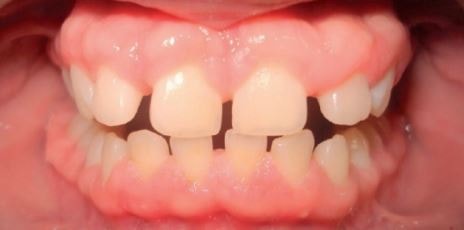 gingival hyperplasia picture
