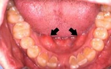 torus mandibularis tori mandibular pl bony english