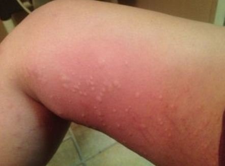 Rash on Inner Thighs