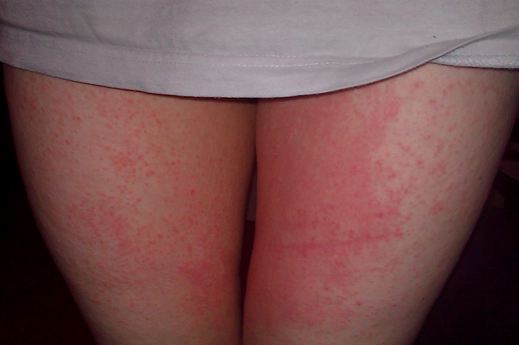both inner thighs have rashes