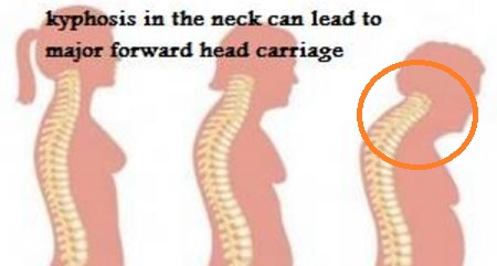 cervical kyphosis picture