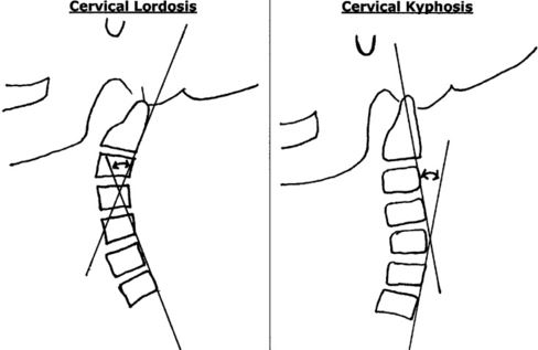 cervical kyphosis vs cervical lordosis