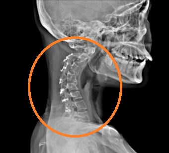 cervical kyphosis x ray