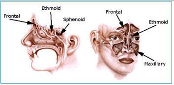 Anatomy of four sinuses - pansinusitis