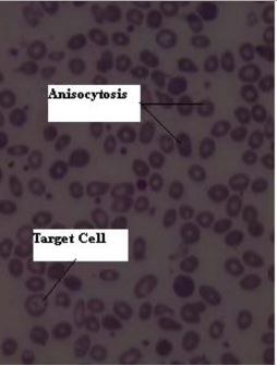 Anisocytosis picture 1