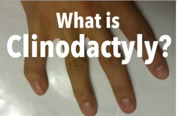 Clinodactyly