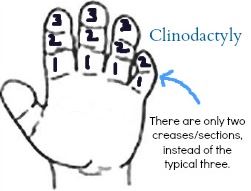 Description of Clinodactyly