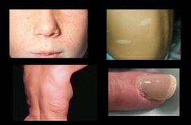In different sites development of tuberous sclerosis