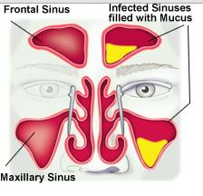 Mucous in sinus glands - pansinusitis