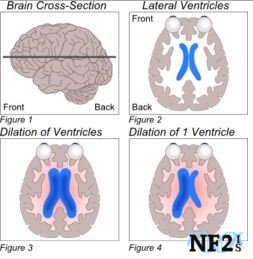 Overview of NF2