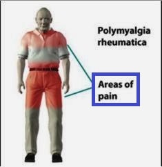 Pain-in-Polymyalgia Rheumatica