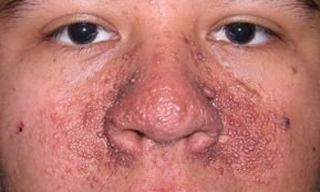 Tuberous Sclerosis