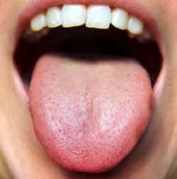 Image result for healthy tongue