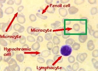 microcytosis