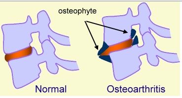 osteophytes