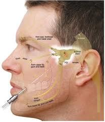 surgical intervention in Trigeminal Neuralgia