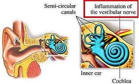 vestibular neuritis picture