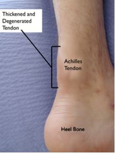 Achilles tendinitis