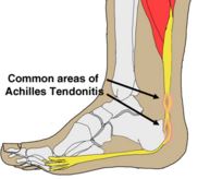 Affected area in achilles tendinitis
