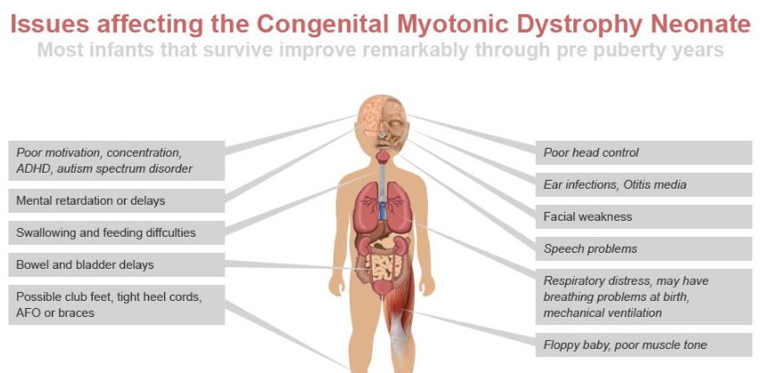 congenital-myotonic-muscular-dystrophy-symptoms-signs