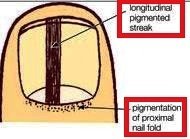 Description-of-Subungual-Melanoma