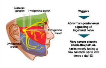 Development-and-symptoms-of-trigeminal-neuralgia