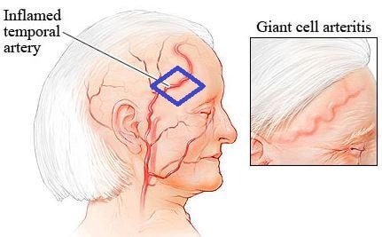 Giant-cell-Arteritis