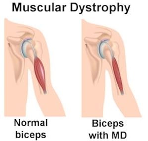 muscular-dystrophy-biceps