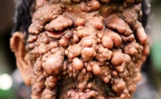 Neurofibromatosis images