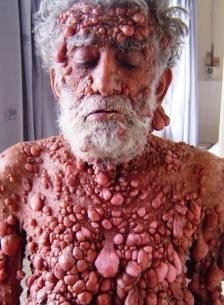 Neurofibromatosis pic