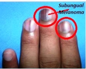 Subungual-Melanoma