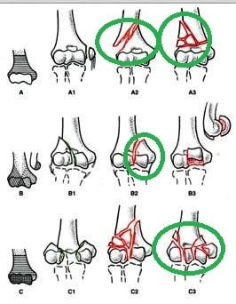 Types-of-Supracondylar-fracture