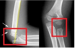 X-ray-Image-of-Supracondylar-Fracture
