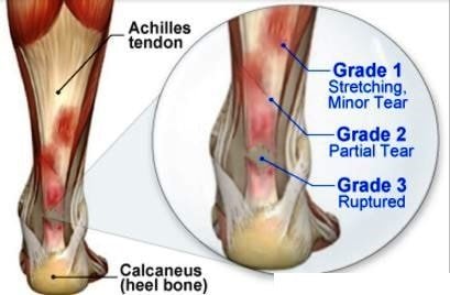 achilles tendinitis grading