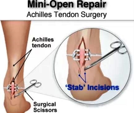 achilles tendinitis mini repair