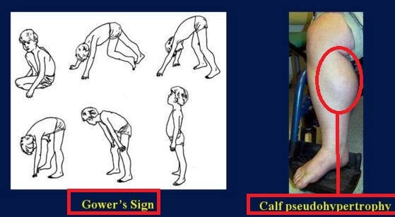 duchenne muscular dystrophy gowers sign calf pseudo hypertrophy