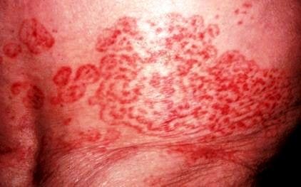 erythema marginatum image