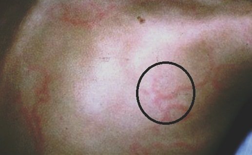 erythema marginatum pic