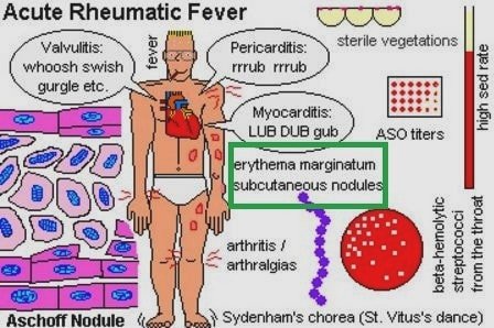 erythema marginatum rheumatic fever