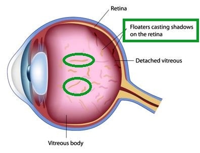floaters in the eye anatomy