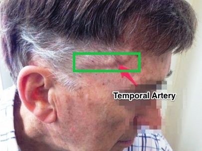 gaint cell arteritis image