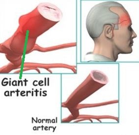 giant cell arteritis gca image