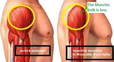 What are the different types of muscular dystrophy?