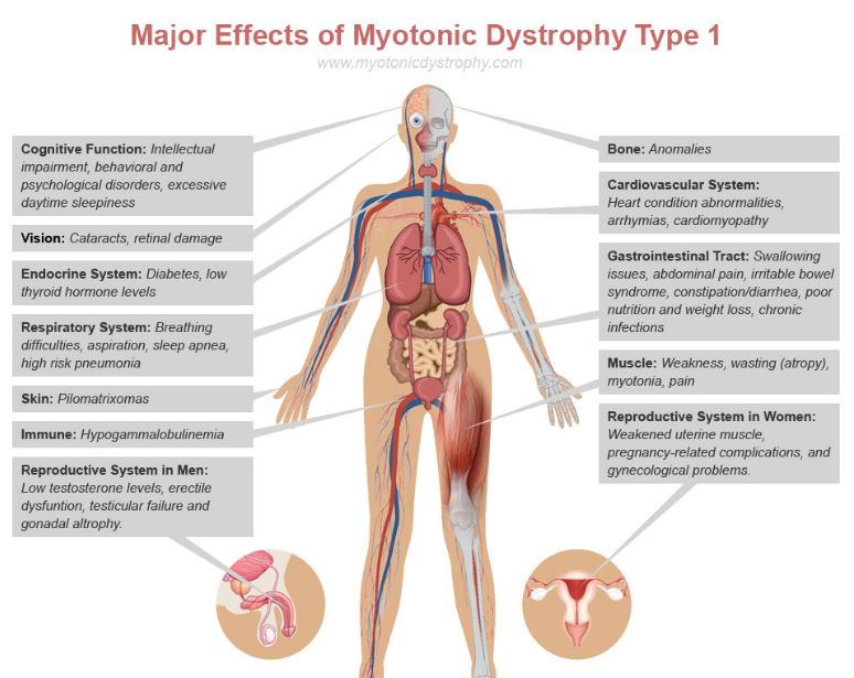 myotonic-dystrophy-type-1-major-effects-symptoms
