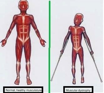 myotonic muscular dystrophy