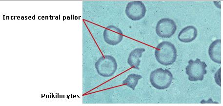 Poikilocytes, Poikilocytosis