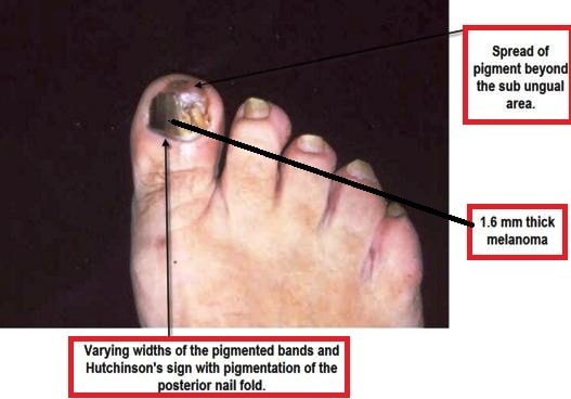 subungual melanoma images