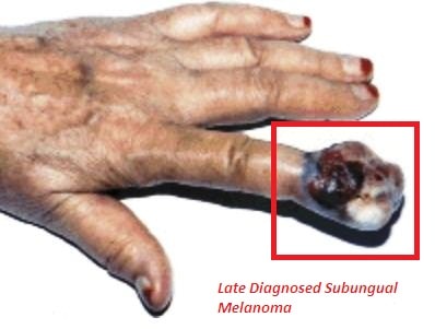subungual melanoma pic late diagnosis